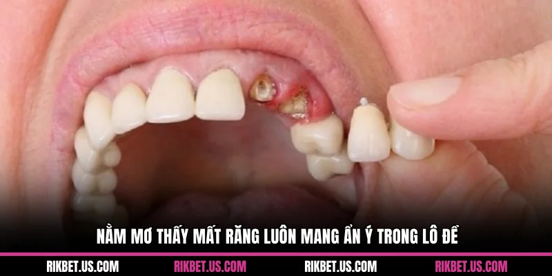 Nằm mơ thấy mất răng luôn mang ẩn ý trong lô đề